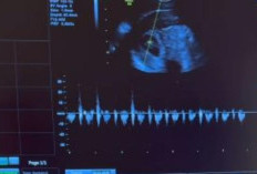 Ini Suami Sosok Siti Sintawati yang Viral Karena Hamil Kembar Setelah 8 Tahun Penantian